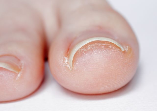 巻き爪の矯正治療